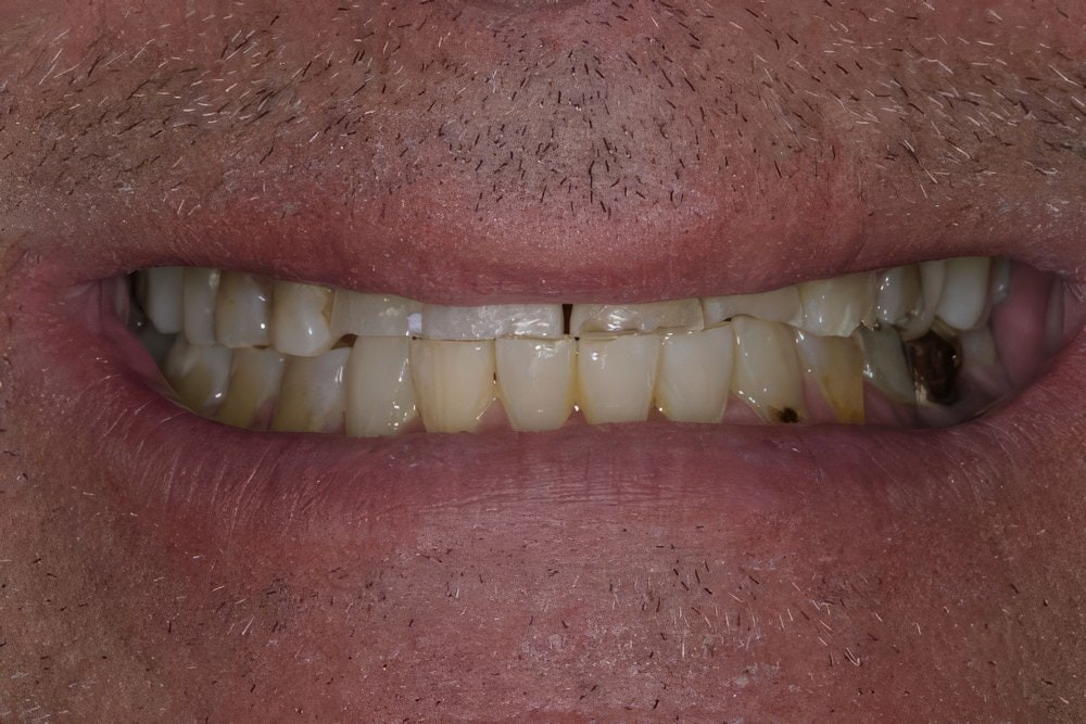 Multiple oral health problems before full mouth reconstruction