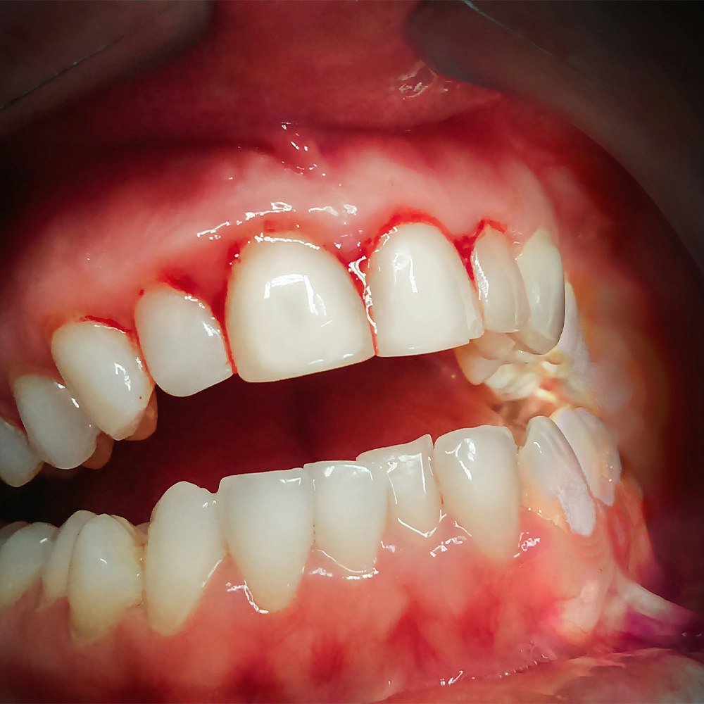 irritated, bleeding gums