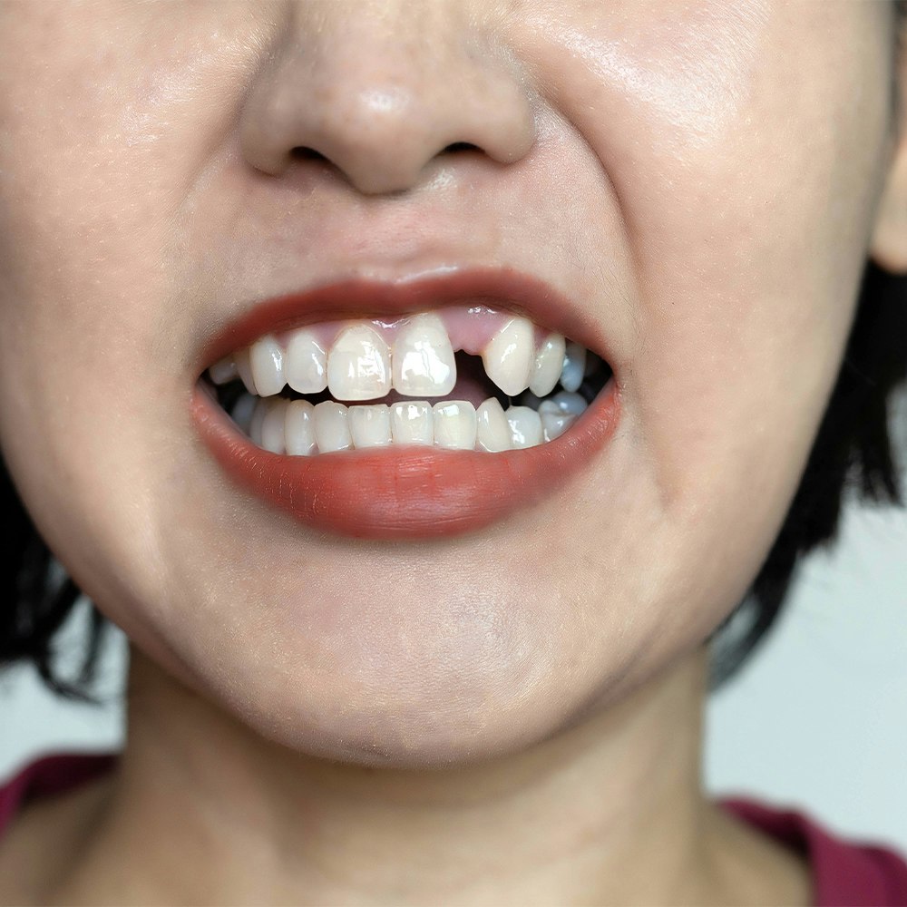 a woman with a missing tooth
