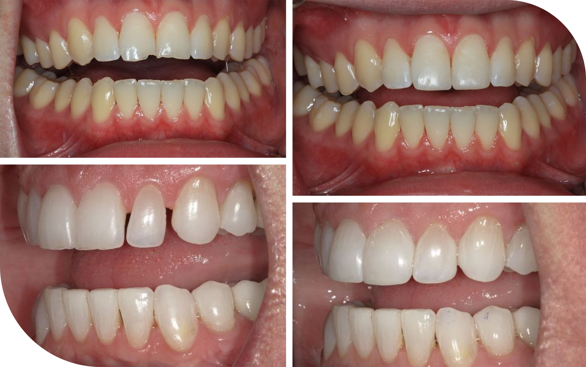 dental bonding results