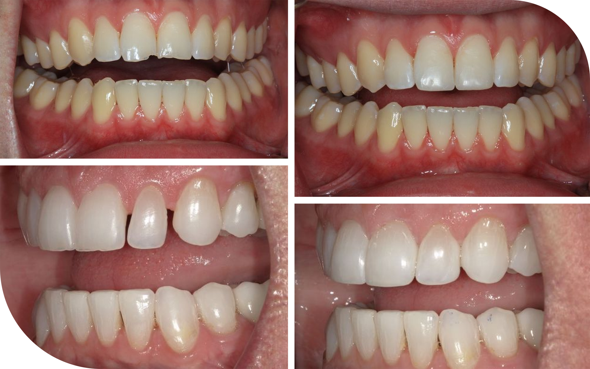 dental bonding results