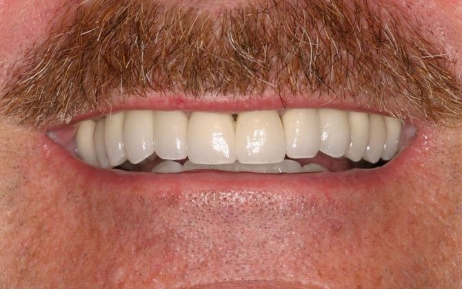 healthy smile after restorative dentistry