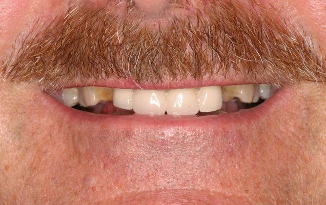 worn smile before restorative dentistry