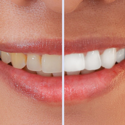 Before and after professional teeth whitening
