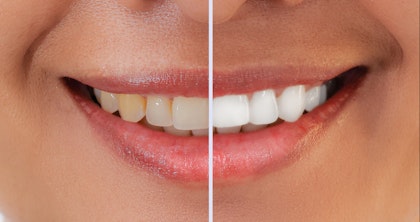 Before and after professional teeth whitening