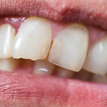 close up of a chipped tooth