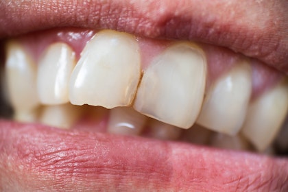 close up of a chipped tooth