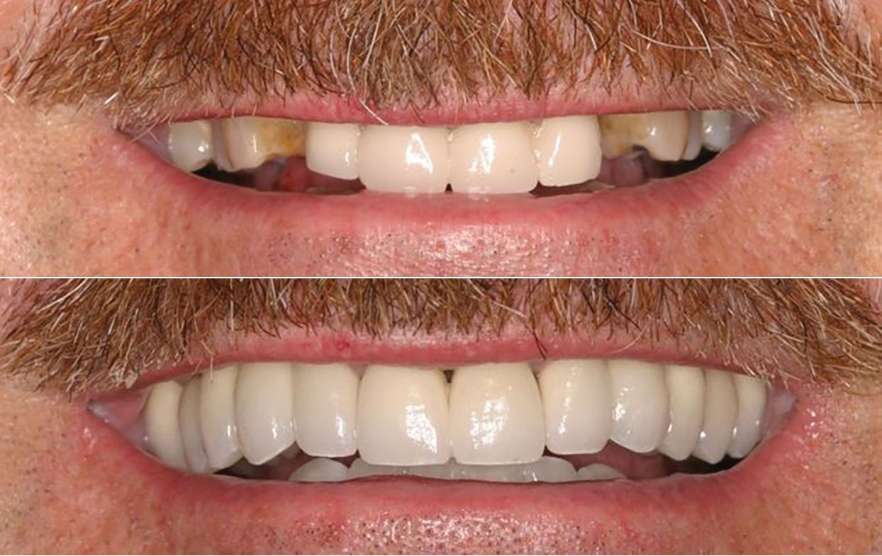 Real patient results. Before patient had tooth decay, after patient has a healthy mouth