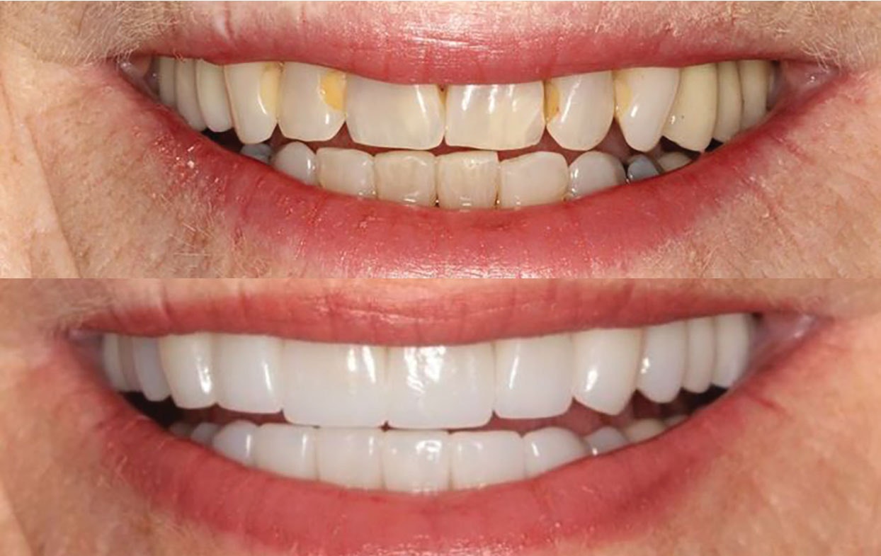 Actual patient before and after full mouth reconstruction