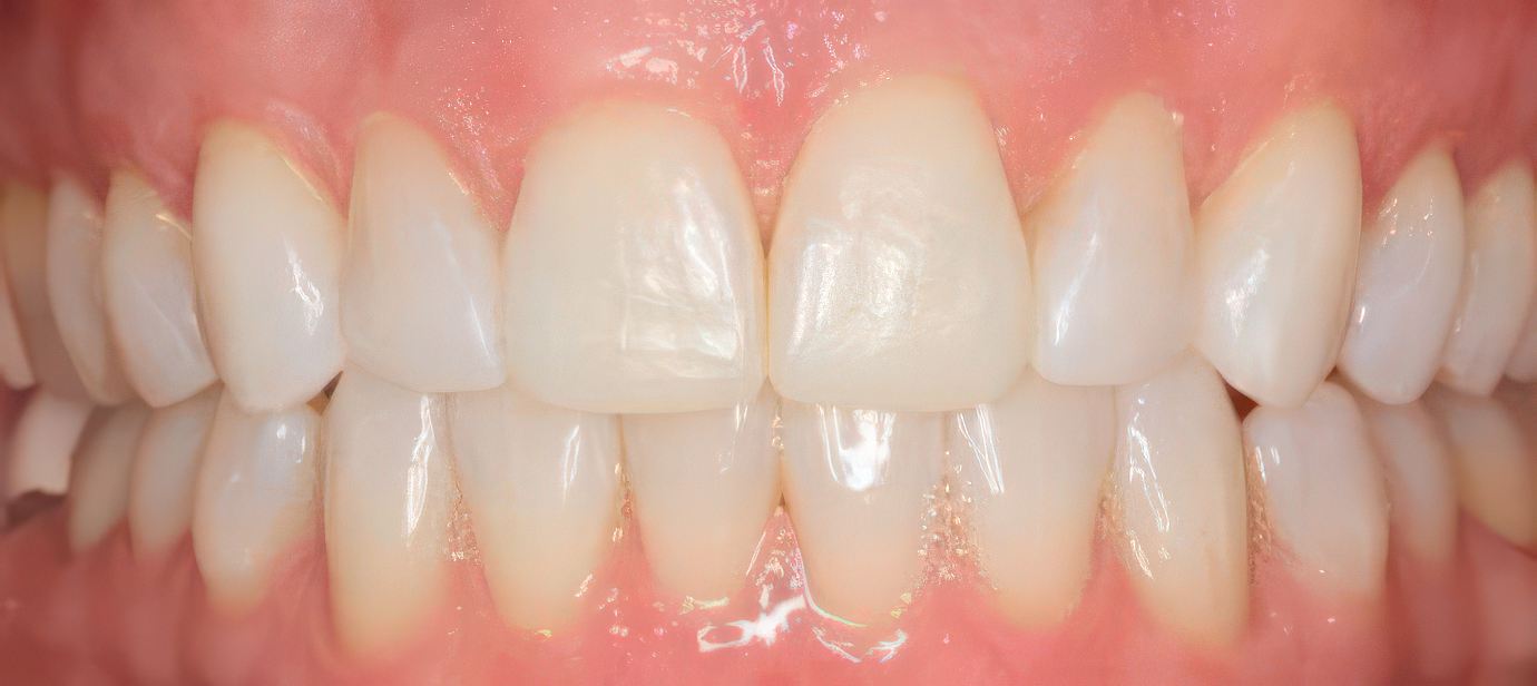 after Invisalign treatment