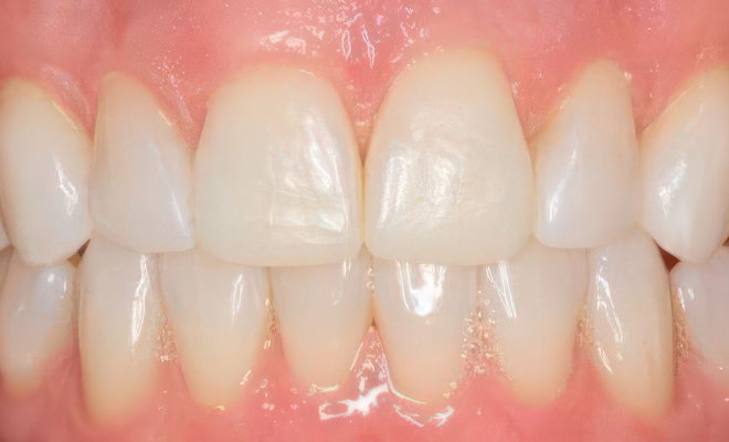 after Invisalign treatment
