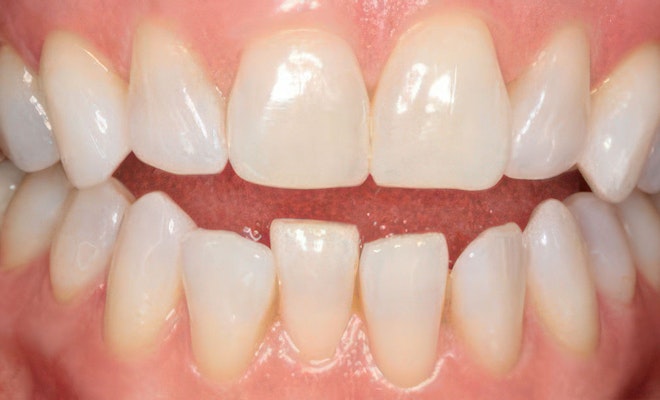 before Invisalign treatment