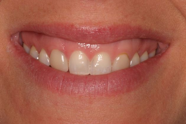 Sonoran Dental Design patient before Veneers and Gum Lift
