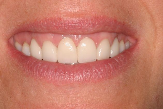 Sonoran Dental Design patient After Veneers and Gum Lift