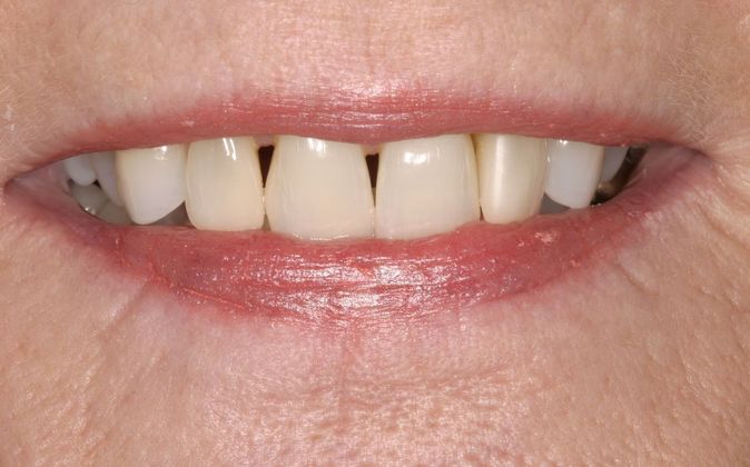 Sonoran Dental Design patient before veneers