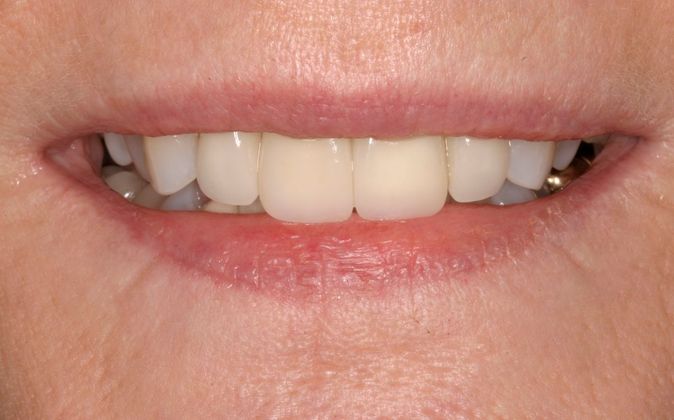 Sonoran Dental Design patient after veneers