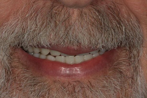 Dr. Ann Sielicki's patient after all-on-4