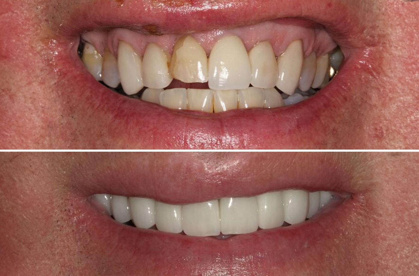 Real patient results. Before patient had tooth decay, after patient has a healthy mouth