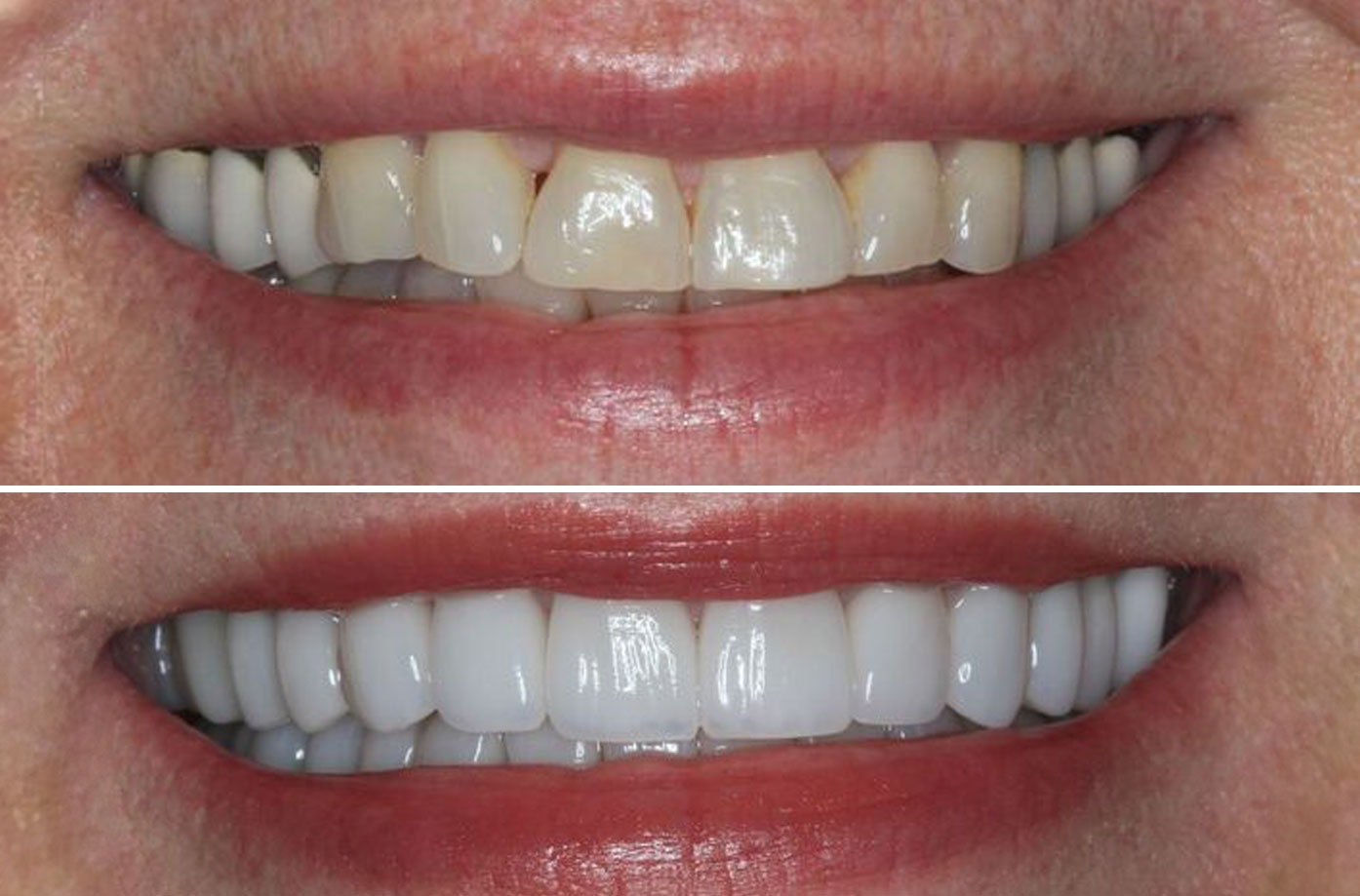 Actual patient before and after full mouth reconstruction