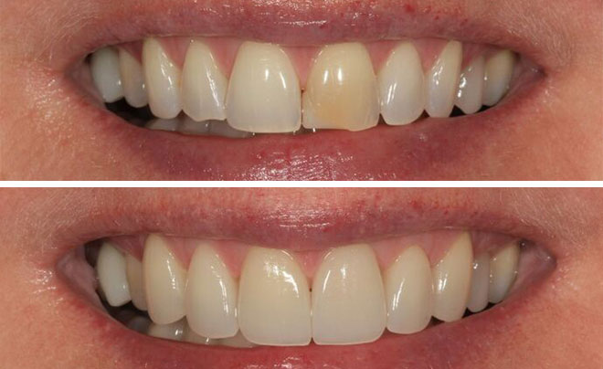 Real patient before and after veneers