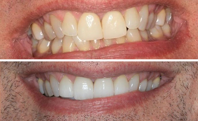 Invisalign bna