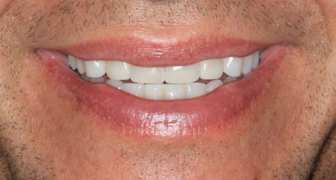 after veneers