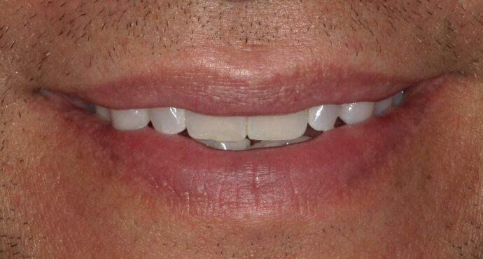 before veneers