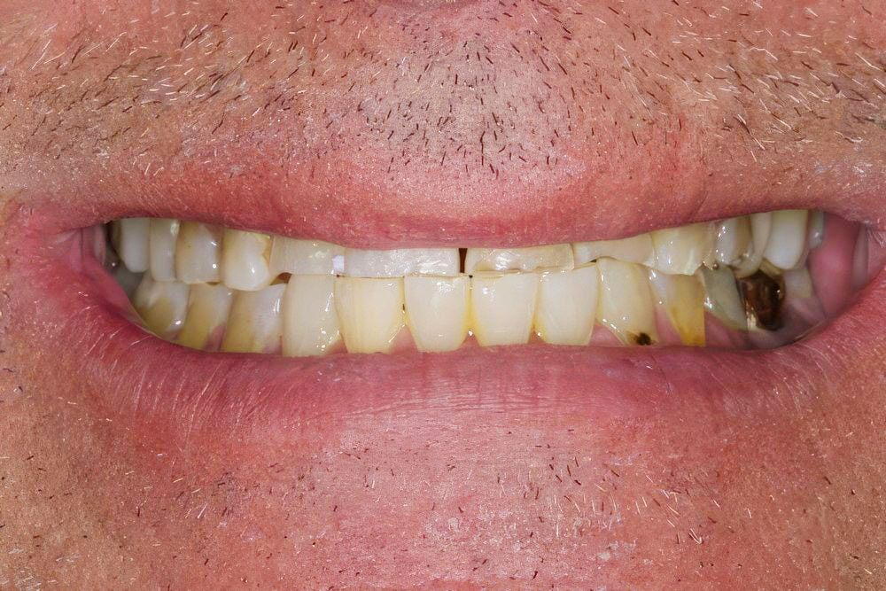 Multiple oral health problems before full mouth reconstruction
