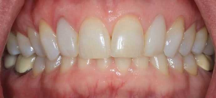 Before KöR Whitening procedure