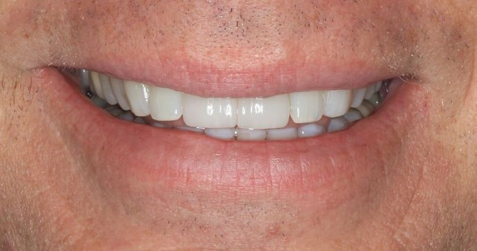 after teeth whitening