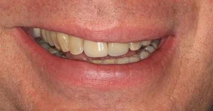 before teeth whitening