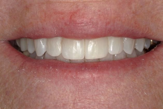 After Invisalign treatment