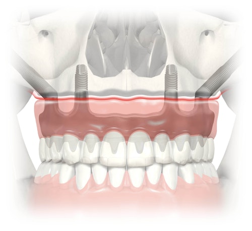 Zygomatic implants diagram