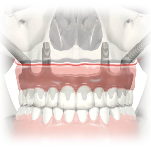 Zygomatic implants diagram