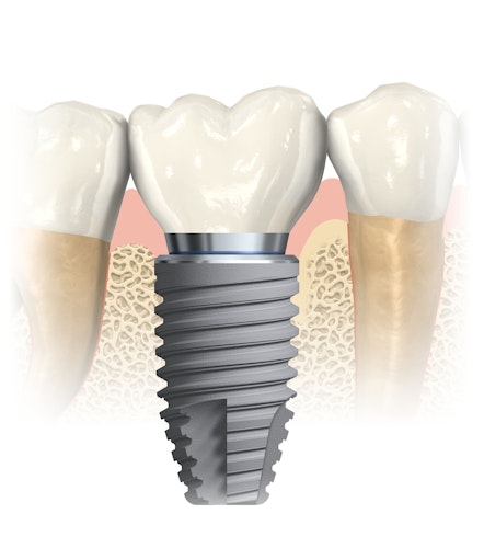 dental implant diagram