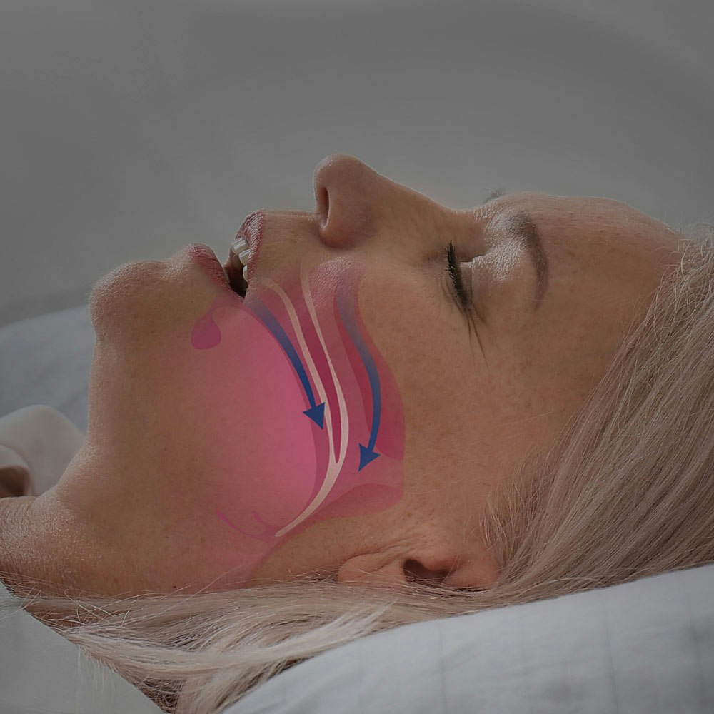 Sleeping woman with an illustration of a blocked airway due to sleep apnea