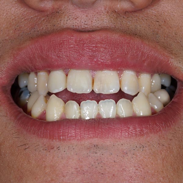 dental misalignment