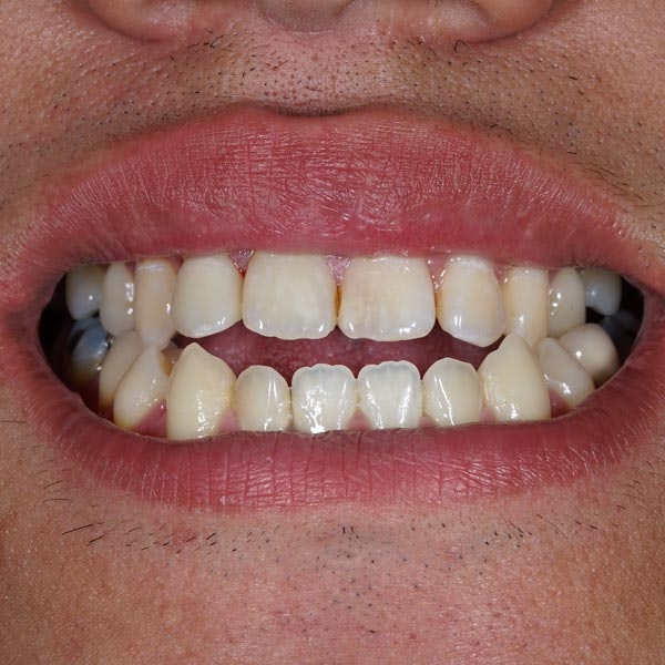 dental misalignment
