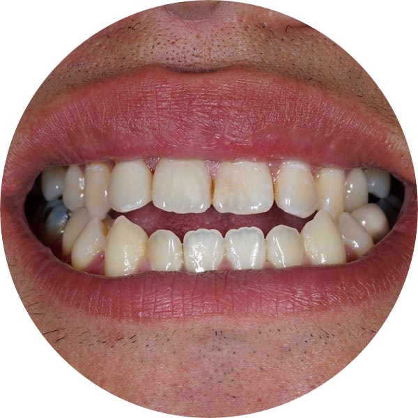 dental misalignment
