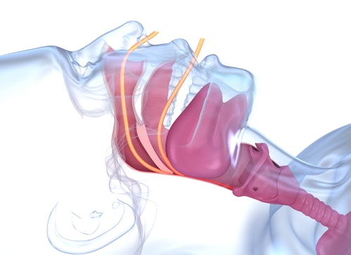 What Is Obstructive Sleep Apnea?: Central Avenue Dental: Comprehensive,  Cosmetic and Implant Dentistry