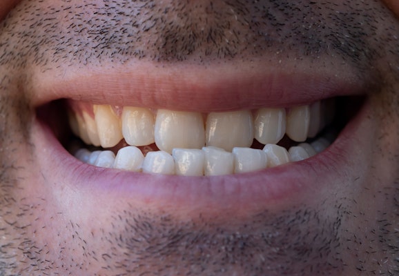 Close-up of a man's teeth