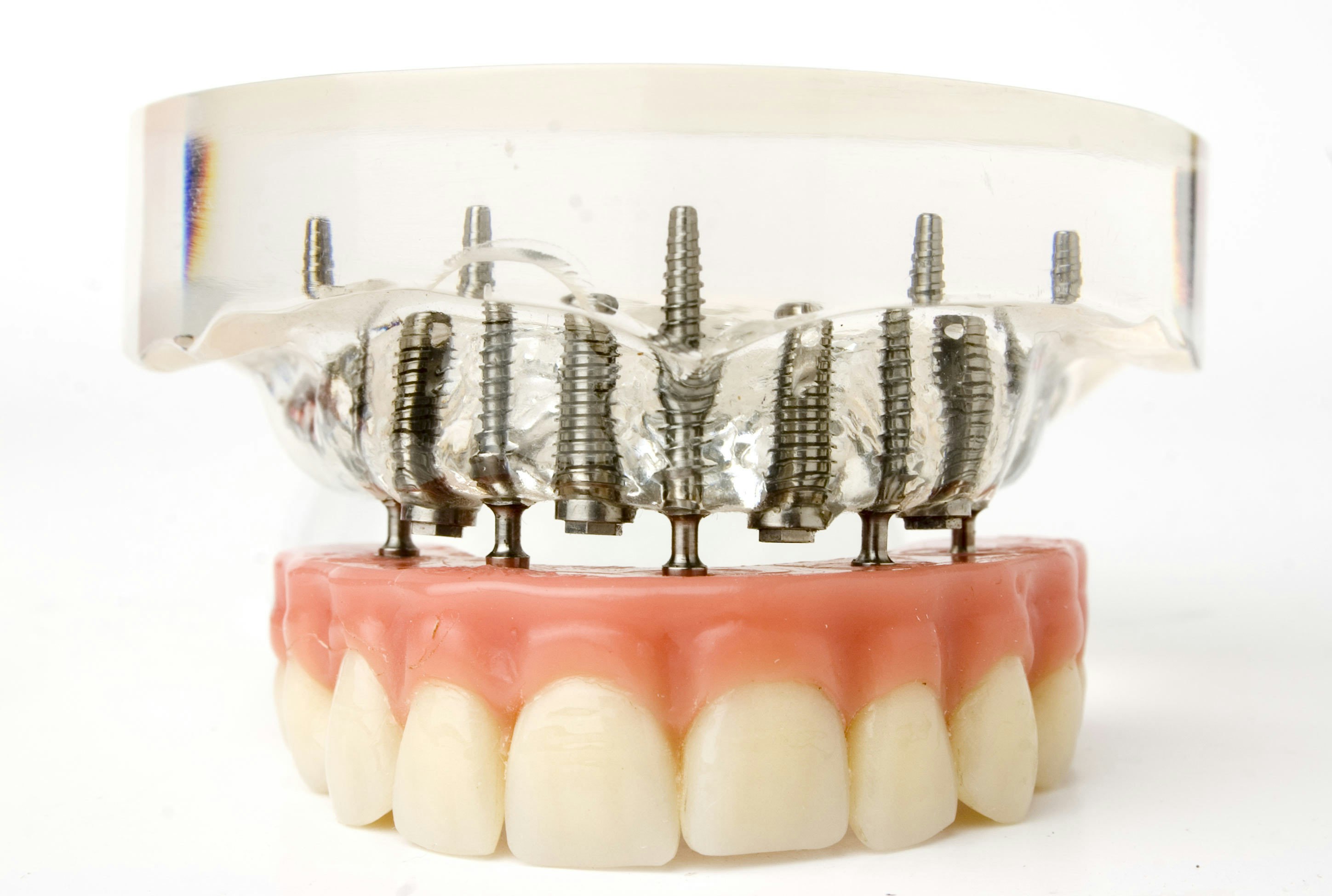 Denture implants