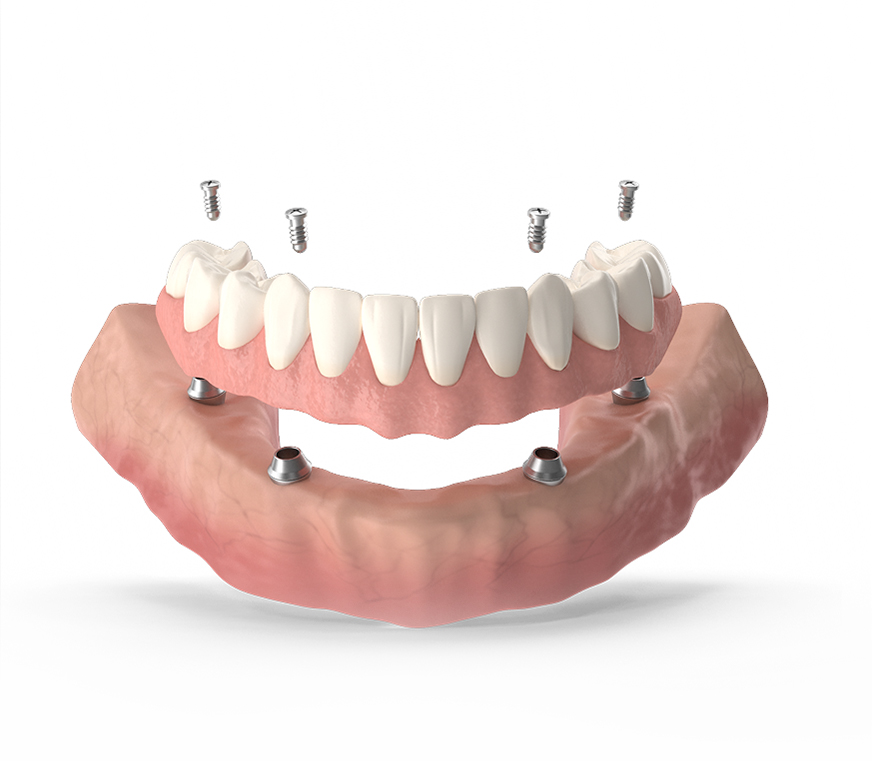 Dental implants