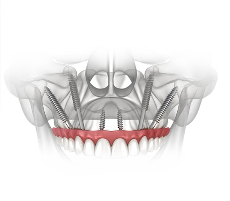 Zygomatic implants