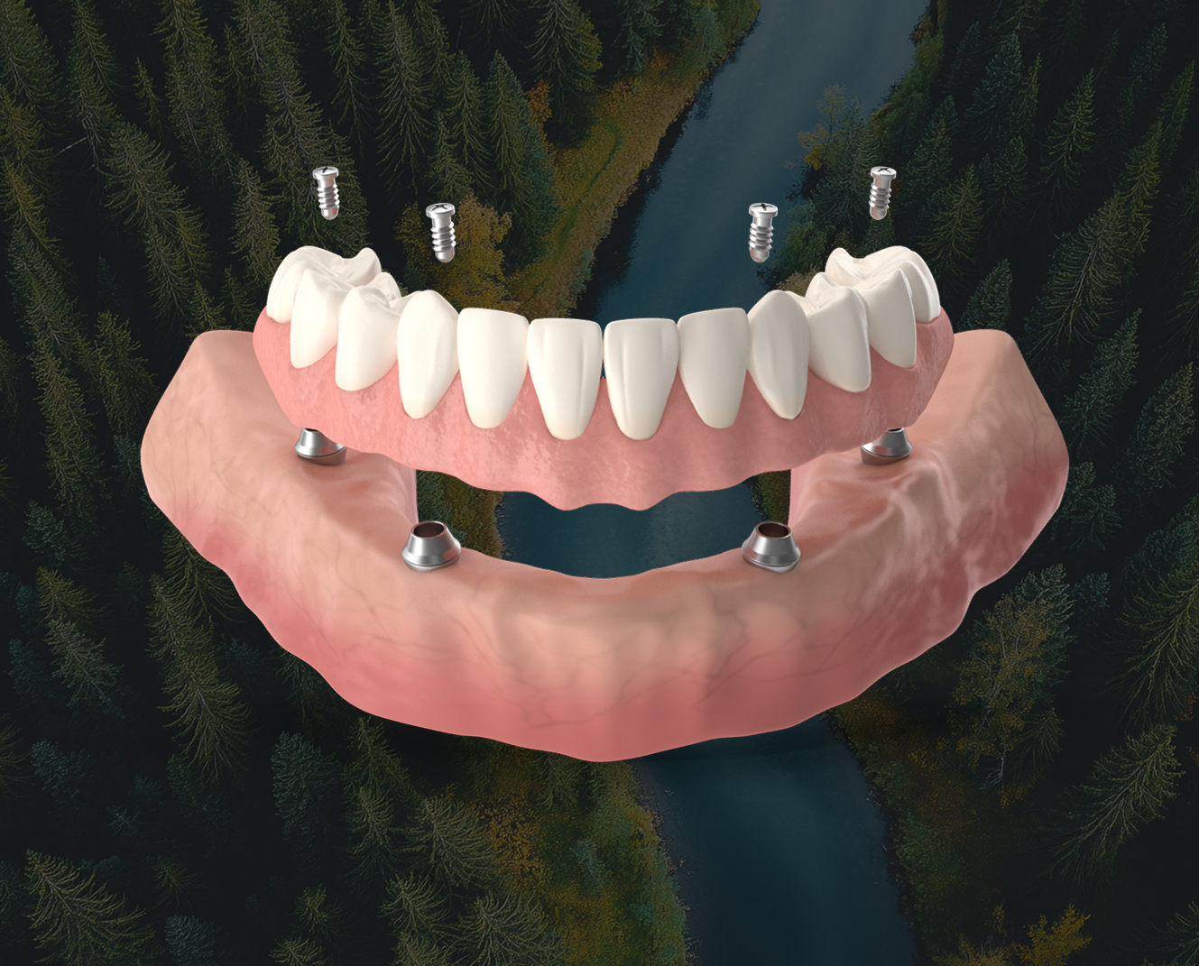 All-on-4 denture