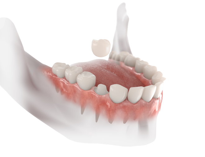 illustration of a dental crown
