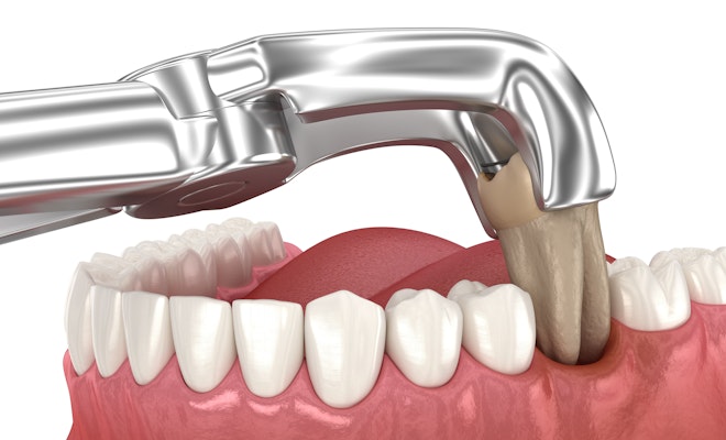 Illustration of a tooth extraction
