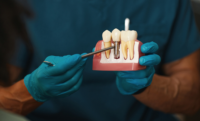 Dentist pointing at a dental implant