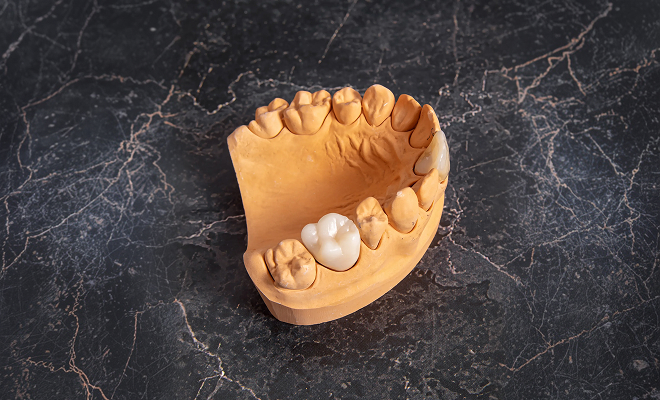 dental crown on model