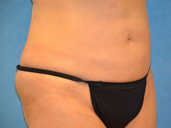 after liposuction